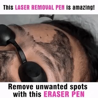 Dual Mode Blue and Red Picosecond Light Pen, Adjustable Intensity for Fading Spots, Freckles and Tattoo Ink